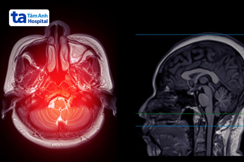Thuốc cản quang hỗ trợ nâng cao chất lượng hình ảnh MRI, làm rõ các tổn thương mô mềm
